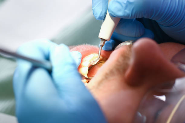 Best Broken Tooth Emergency  in Riverbend, WA