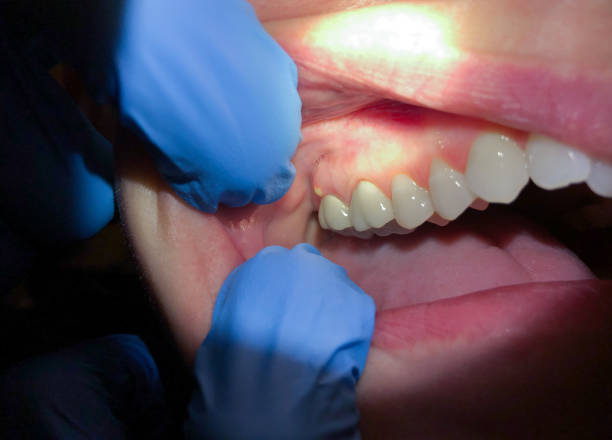 Best Chipped Tooth Repair Near Me  in Riverbend, WA